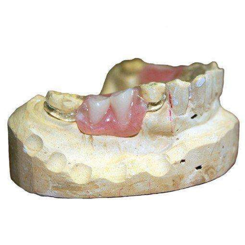 Itsoclear Molar Clasps – 2.2mm thick – 6/Pkg